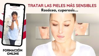 Cómo tratar las pieles más sensibles Rosácea Cuperosis [upl. by Arrat]