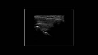 Subacromial impingement on dynamic realtime shoulder ultrasound [upl. by Nomla]