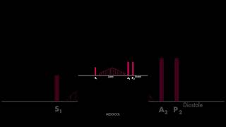 Atrial Septal Defect Heart Sound [upl. by Anwahsat820]