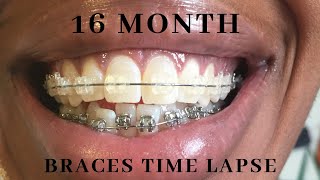 Full Braces Time Lapse  Adult Braces Before amp After [upl. by Chauncey317]