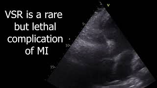 Cardiogenic shock due to VSR [upl. by Lemra968]