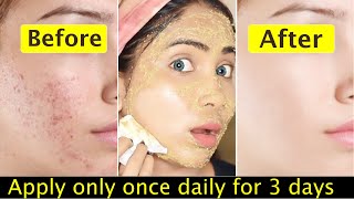 Teenager Skin Transformation ChallengePimples whiteheads acne marks clearing amp face brightening [upl. by Ettelohcin]