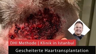 Gescheiterte Haartransplantation mit der DHI Methode in Istanbul [upl. by Harle516]