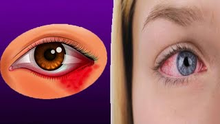 Eye Herpes Causes And Treatment [upl. by Wenger782]