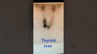 Thyroid scan nuclear medicine technologist pet thyroid nuclear gamma radiological radiography [upl. by Idelson]