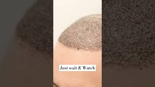 Amazing Hair Transformation hairtransformtion hairtransplant [upl. by Madelin134]