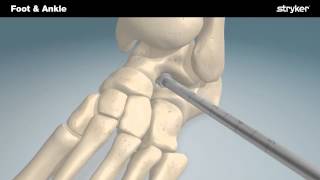 Stryker Foot and Ankle  SubFix™ Arthroeresis Implant Animation [upl. by Annayehc]