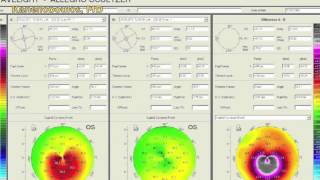 Placido disc versus Scheimpflug imaging in progressive keratoconus  Video abstract 44745 [upl. by Pump898]