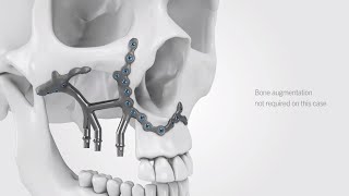 IPS Implants® Preprosthetic  Treatment workflow [upl. by Sparks]