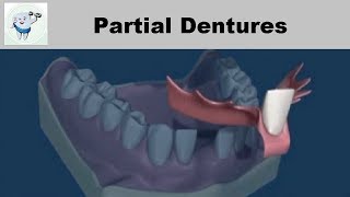 Removable Partial Denture  Reviewing design and how to draw [upl. by Naniac]