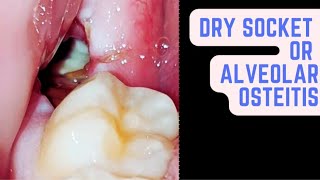 Dry socket  Alveolar osteitis [upl. by Akihsal481]