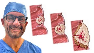 Treating Colon Cancer  What You Need to Know [upl. by Neiht890]