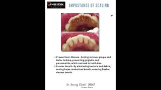 Dental Scaling  Teeth cleaning [upl. by Acie]