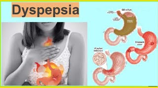 Dyspepsia  Functional Dyspepsia  Organic Dyspepsia Heart Burn Hindi  UrduTडिस्पेप्सिया [upl. by Oiramed]