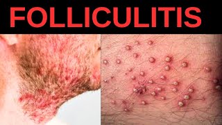 What is Folliculitis Causes Symptoms Treatment [upl. by Barrie]