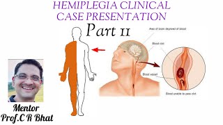 HEMIPLEGIA Clinical case presentation Part 2 [upl. by Rebna]