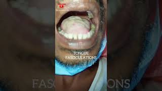 Tongue Fasciculations  Motor Neuron Disease  Dr Shankar Dey [upl. by Marrilee]