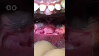 Elongated Soft Palate in French Bulldog amp BOAS [upl. by Narmak825]