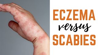 Scabies vs Eczema Causes Symptoms amp Treatments [upl. by Damien]