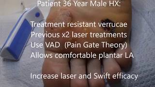 Painless Laser and Swift Plantar Verruca Treatment using a Vibration Anaesthesia Device [upl. by Akenom]