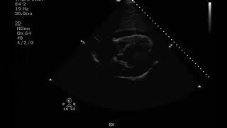 Video2 crop Subxiphoid view Pericardial effusion [upl. by Aerdnuahs]