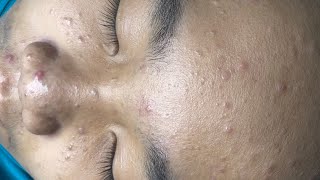 ACNE TREATMENT VU QUYNH MI  Blackheads Chin amp Nose Of Tweens 2024 EX [upl. by Adnocahs]