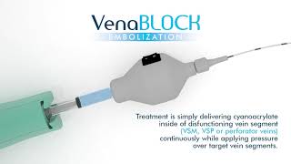 VenaBLOCK®️ Vein Sealing System Non Thermal Ablation [upl. by Rudyard]