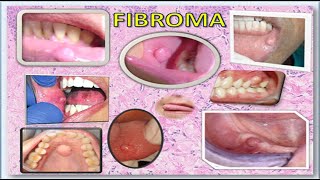 Fibroma [upl. by Howenstein806]