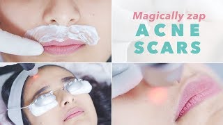 Get Rid of Acne Scars Pigmentation amp Blemishes  Picosure Laser [upl. by Oirretna]