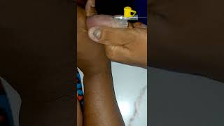 IV Cannulation Procedure technique mbbs shortvideo [upl. by Hannibal]