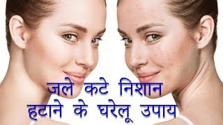 जले कटे निशान हटाने के घरेलू नुस्खे  How to Remove Pimples [upl. by Eul112]