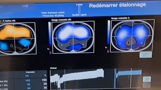 Electrical Impedance Tomography Dorsal Atelectasis corrected with APRV  Proning [upl. by Virginia694]