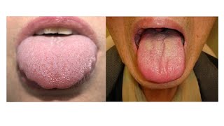 CLINICAL SIGNIFICANCE OF ENLARGED TONGUE amp ATROPHIED TONGUE [upl. by Valry874]