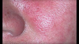 Rosacea  What is it [upl. by Sethi789]