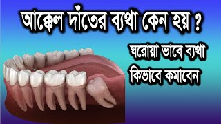 আক্কেল দাঁতের ব্যথার কারন  Wisdom Teeth Pain Relief In Bangla  Akkel Date Betha Hole Koronio [upl. by Ardnazil]