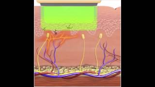 How IPL  Photorejuvenation works for Vascular Lesions [upl. by Nevet226]