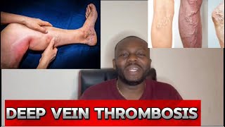 Causes And Effects Of Deep Veins Thrombosis dvt [upl. by Miof Mela]