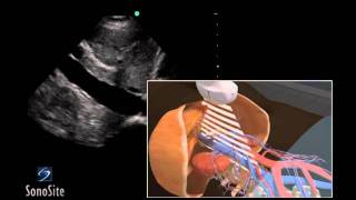 How to Inferior Vena Cava Ultrasound Exam 3D Video [upl. by Keeler]