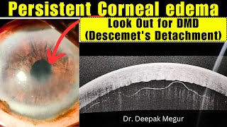 Inferior Descemets Membrane Detachment DMD Management Dr Deepak Megur [upl. by Nivle]