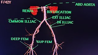 CT Lower Limb Angiography Anatomy CT scanPhilips avnishradiologyPart2 [upl. by Sergent]