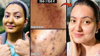 कितने भी मुश्किल झाइयाँ काले धब्बे Dark Spots Pigmentation हो इस Remedy से होगा 100 इलाज💕 [upl. by Holbrook52]