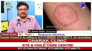 Ringworm Infections in children  why does it happen and how to prevent and treat it [upl. by Ettenil]