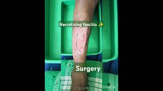 necrotising fasciitis vericosevein complicates surgery✨🩺🏥🏥🩺💊⛑️⛑️Sudarshanlipane17 [upl. by Narod]