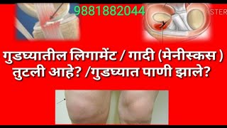 गुडघ्यातील लिगामेंट तुटली ligament tearगादी फाटली Meniscus tear यासाठी यशस्वी आयुर्वेदिक उपचार [upl. by Budde]