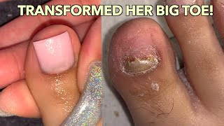 BIG TOENAIL TRANSFORMATION ACRYLIC BIG TOENAIL [upl. by Southworth258]