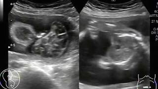 Ultrasound Video showing anencephaly with polyhydramnios [upl. by Joyan]