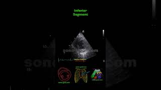 Echocardiography  Inferolateral And Inferior Hypokinesia [upl. by Niddala345]