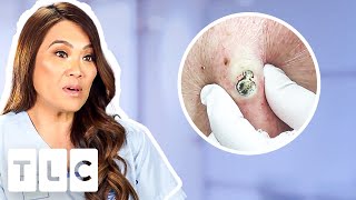 Top 5 Pimple Popping Moments From A 55YearOld Blackhead To Oozing Fistulas [upl. by Yaresed]