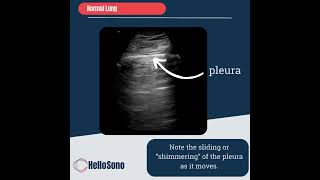 Lung Ultrasound for Beginners Pneumothorax [upl. by Damha]