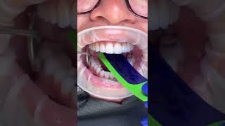 Dentist uses film to test tooth bite Note the bluefullingDIYdentist badbreath 🦷beadrepair [upl. by Atiuqa]